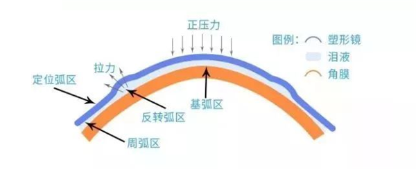 角膜塑形镜采用反几何设计原理,能够压平眼角膜的中央曲率,降低