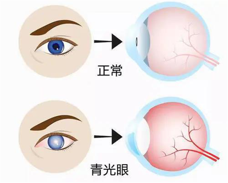 秦女士左眼前房已经消失,瞳孔膜闭,出现恶性青光眼的体征,同时伴有
