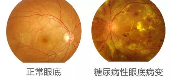 高血压等全身性疾病和高度近视,都可能诱发眼底疾病,而由于白内障的